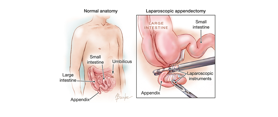 Appendectomy Surgery