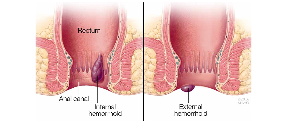 Hemorrhoids Surgery