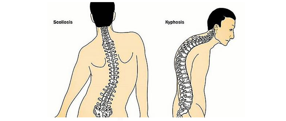 Kyphosis Surgery