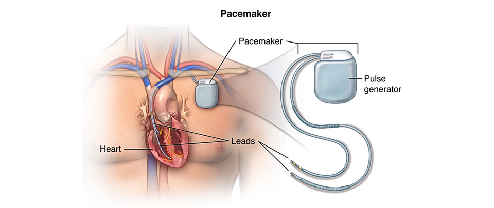 pacemaker implant surgery