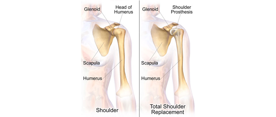 Shoulder Replacement Surgery